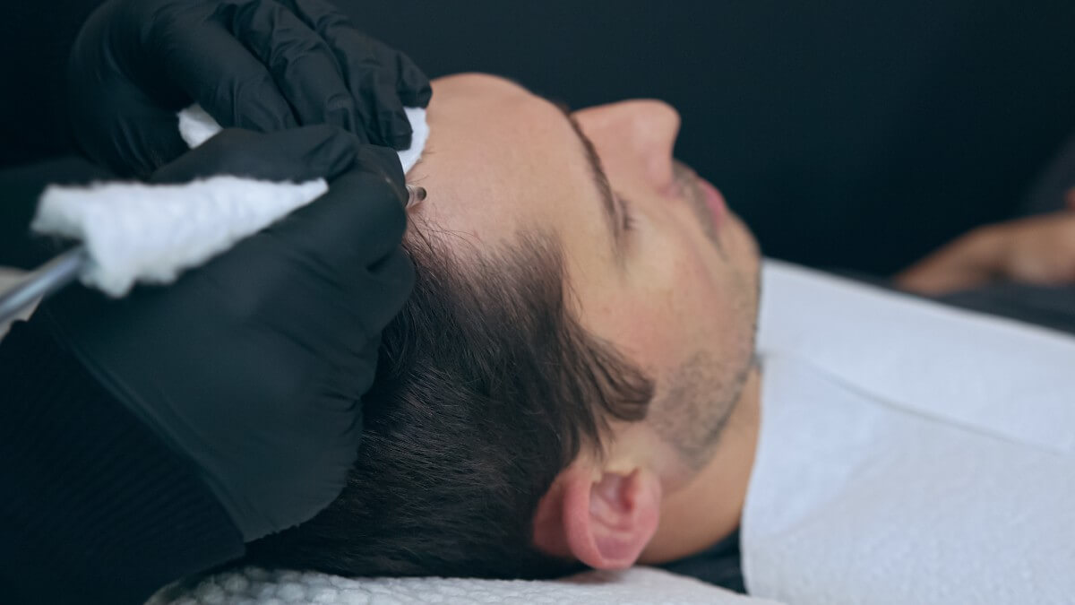 man having scalp micropigmentation