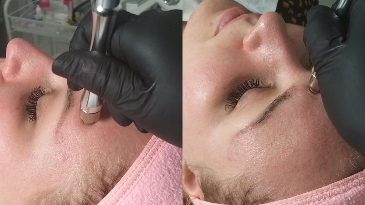 Microdermabrasion Treatment