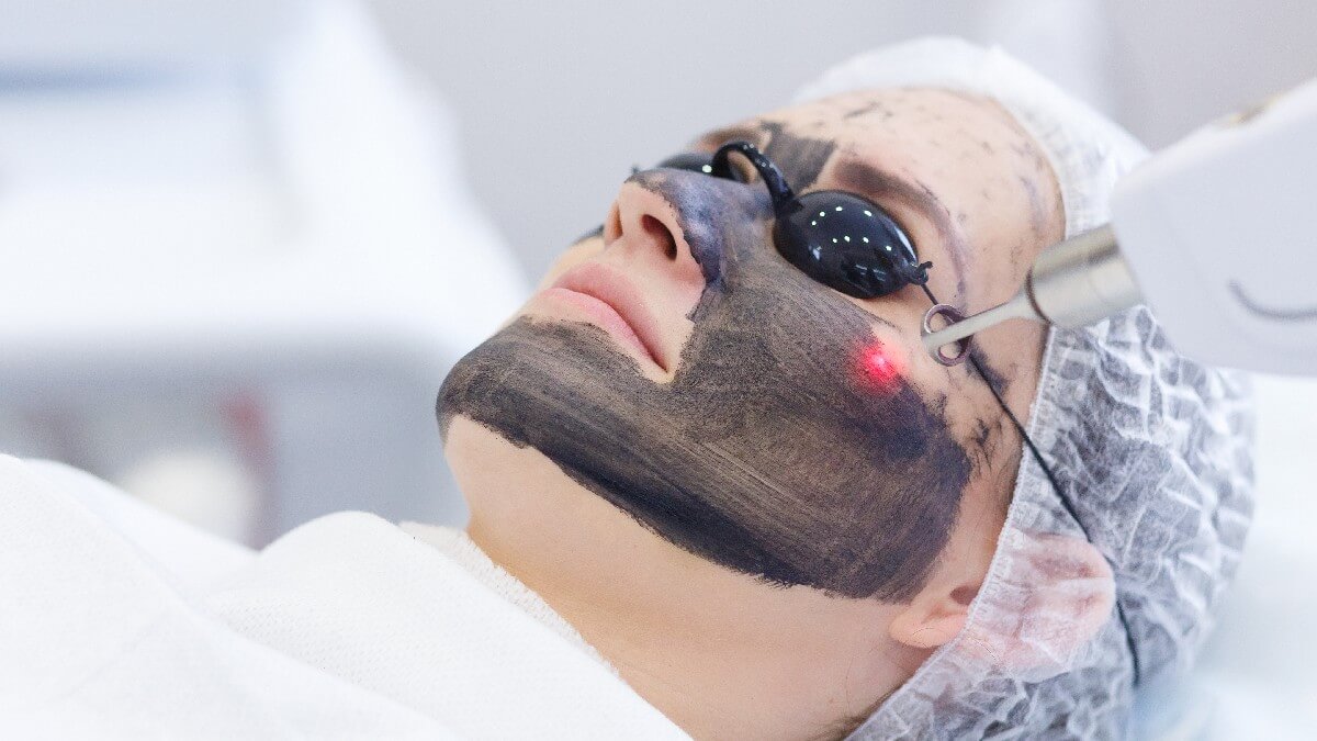 laser carbon peel