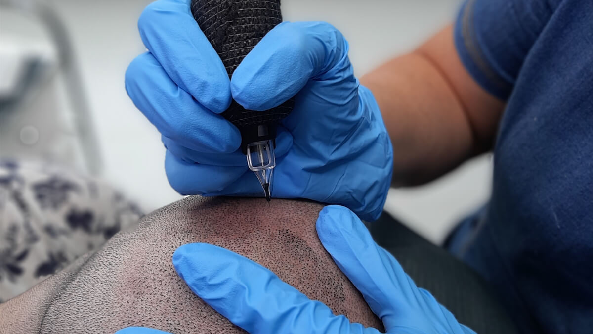 Scalp Micropigmentation