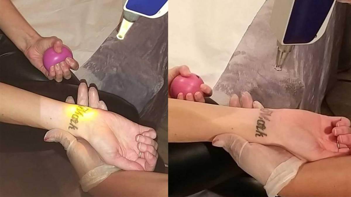 During Laser Tattoo Removal Session